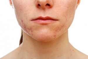 getting-rid-of-acne-scars-fast